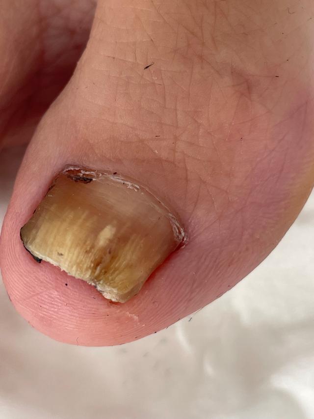 before Fungal Nail Treatment treatment