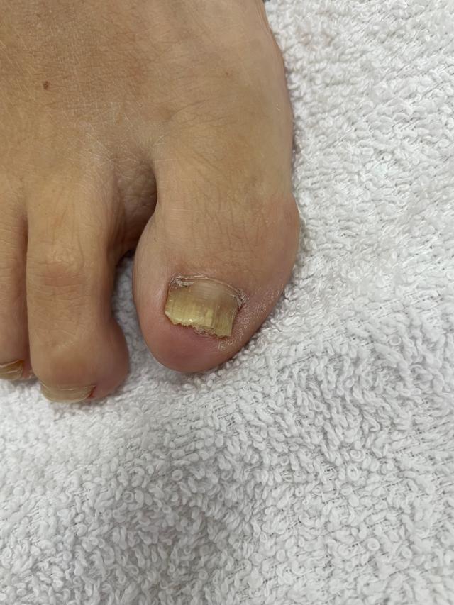 after Fungal Nail Treatment treatment