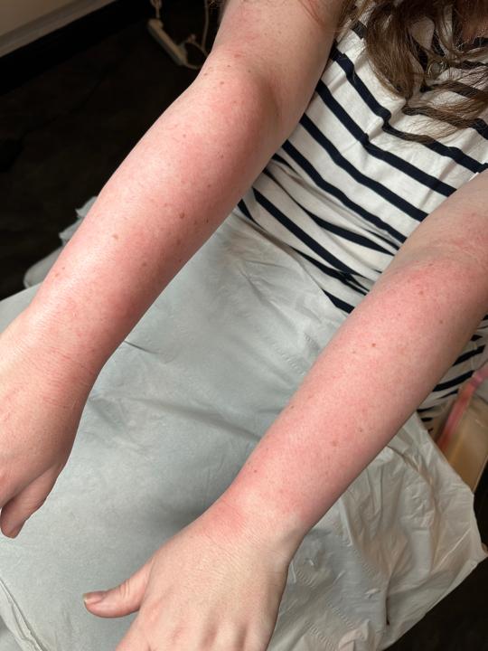 after Leg Wax treatment
