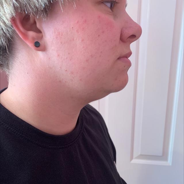 before Neck Lift