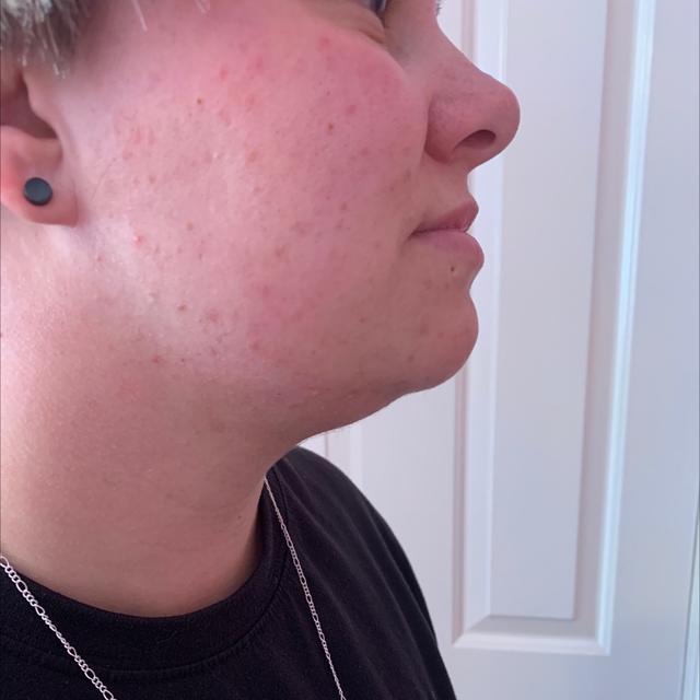 after Neck Lift