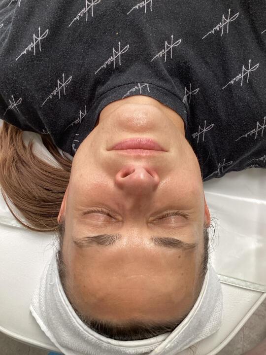 after Body Sculpting treatment