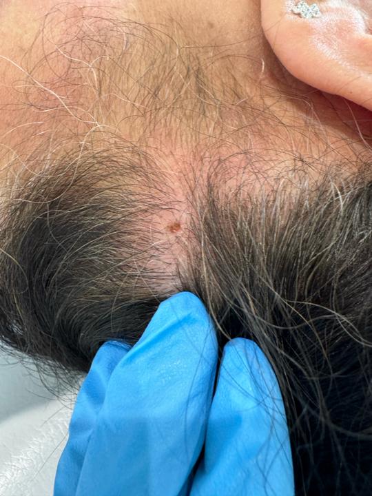 after Skin Tag Removal