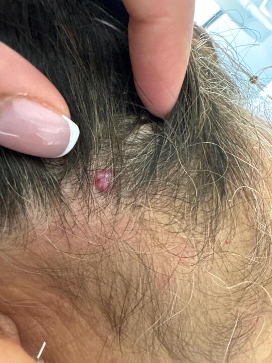 before Skin Tag Removal
