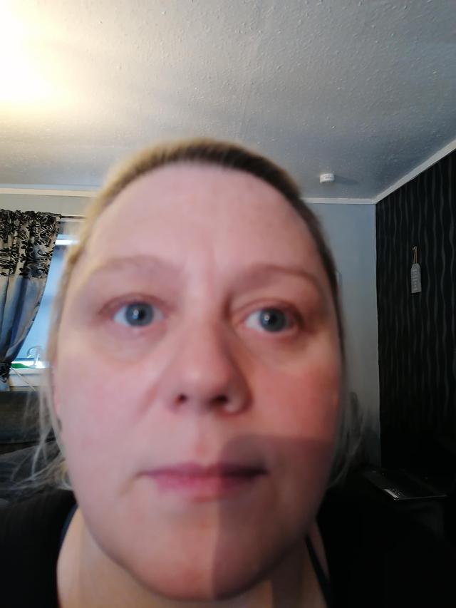 before Tear Trough Filler