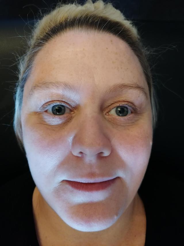 look before Tear Trough Filler treatment
