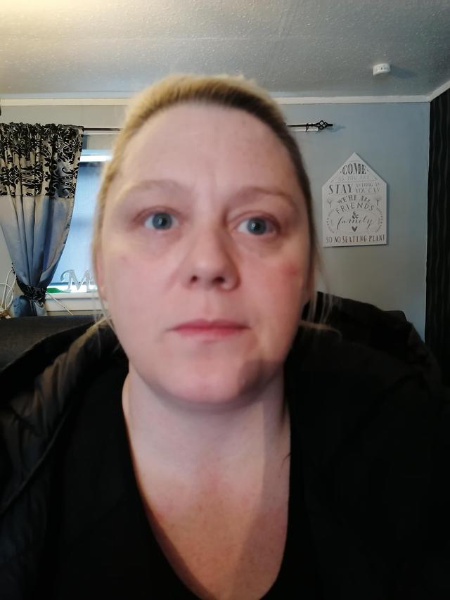 look after Tear Trough Filler treatment