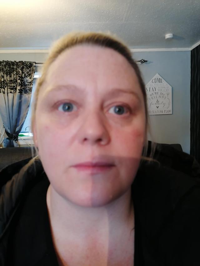 after Tear Trough Filler