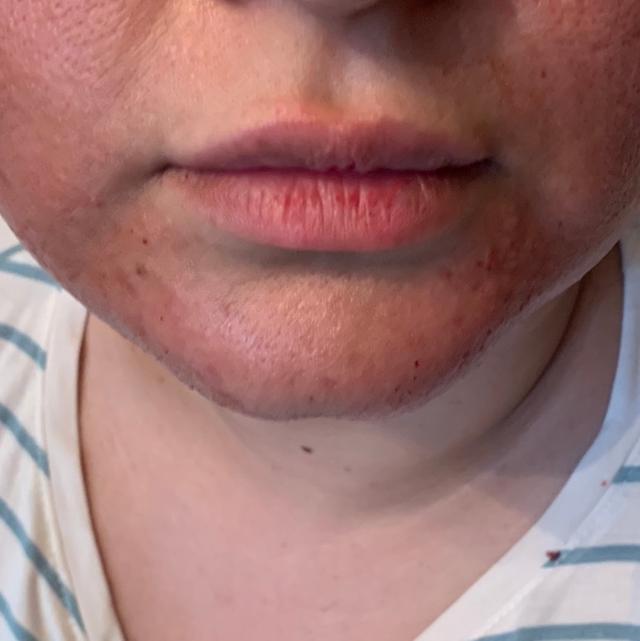 before PRP treatment