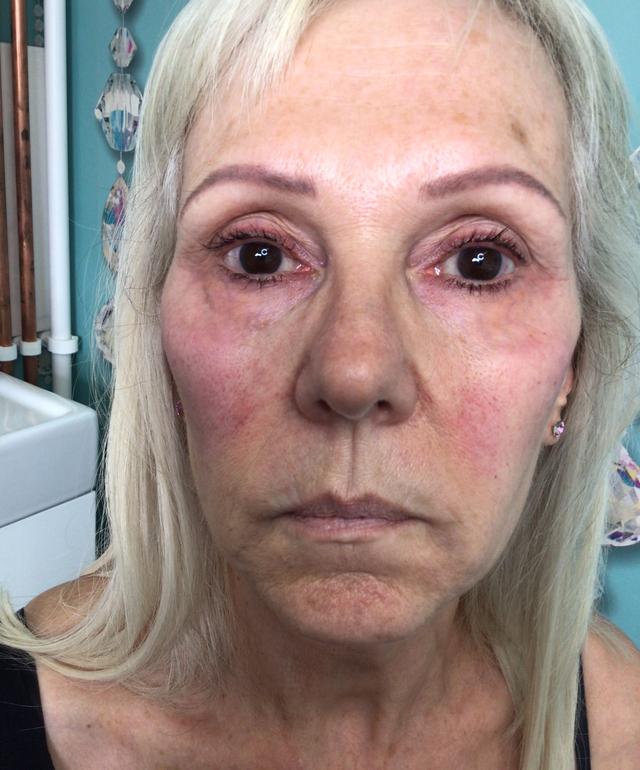 before Cheek Filler