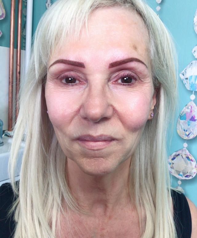 after Cheek Filler