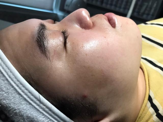 after LED Light Therapy treatment
