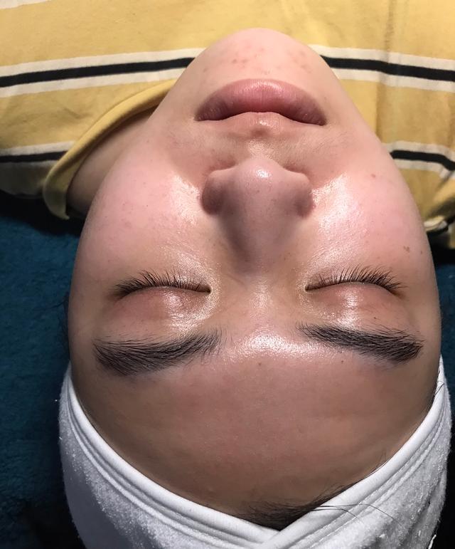 look after LED Light Therapy treatment