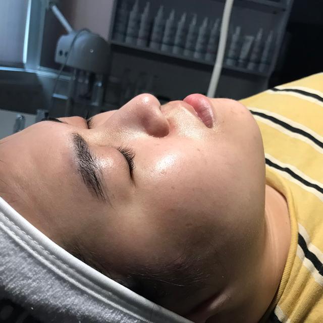 before LED Light Therapy treatment