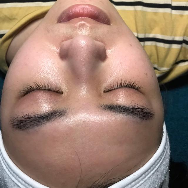 look before LED Light Therapy treatment
