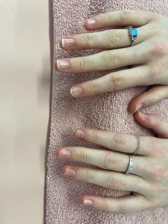 before Acrylic Nails treatment
