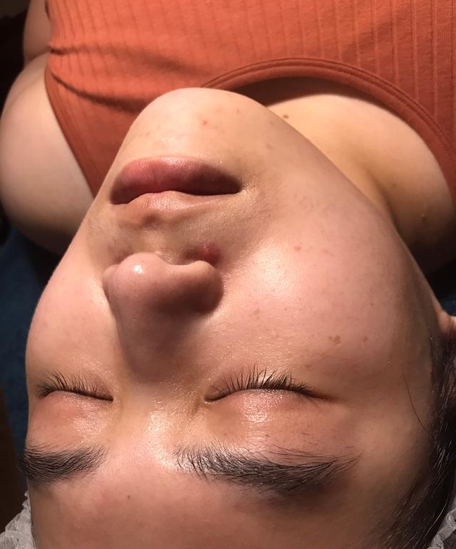before LED Light Therapy