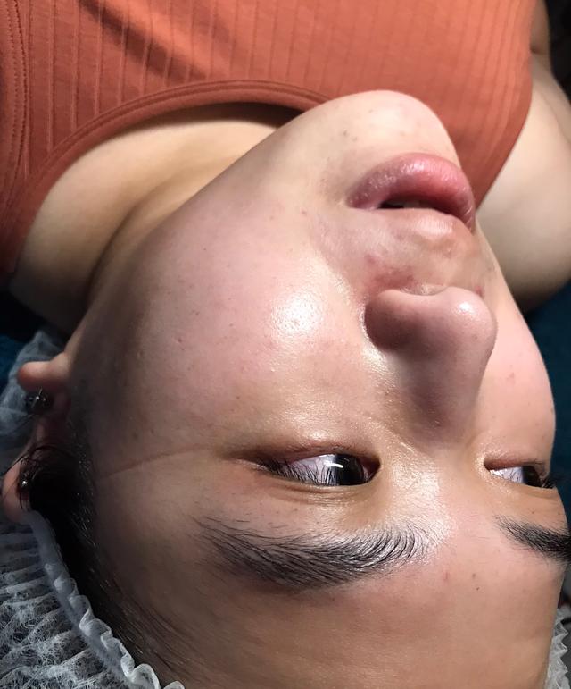 after LED Light Therapy