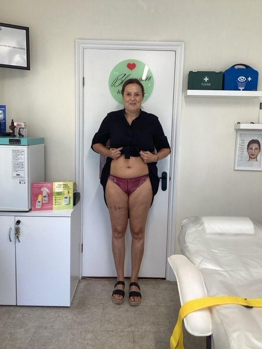 look before Body Sculpting treatment