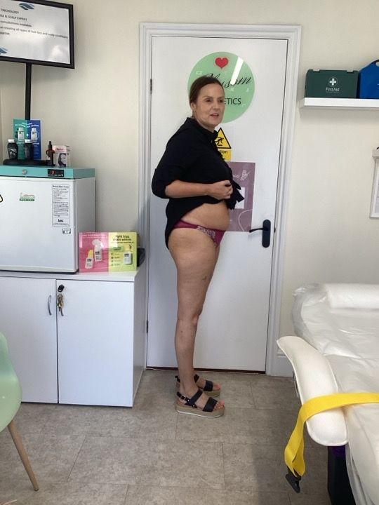 look after Body Sculpting treatment