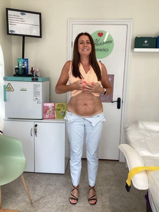 before Body Sculpting