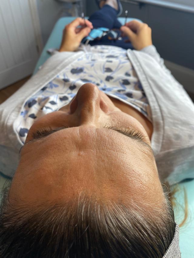 after Facial Fillers