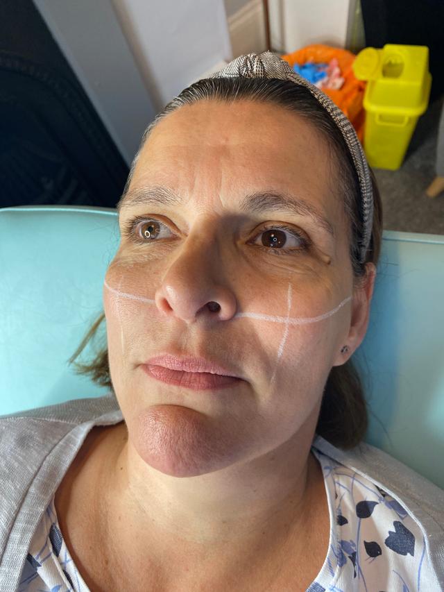 before Facial Fillers