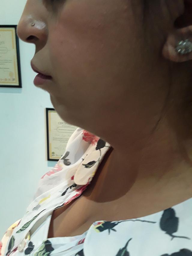 after Neck Lift treatment