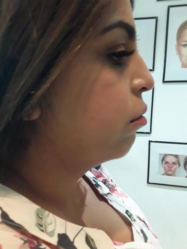 before Neck Lift treatment