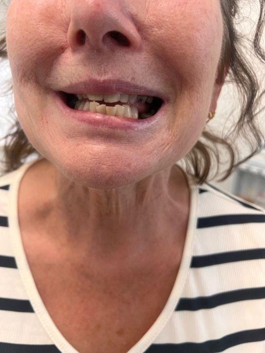 look after Neck Lift treatment