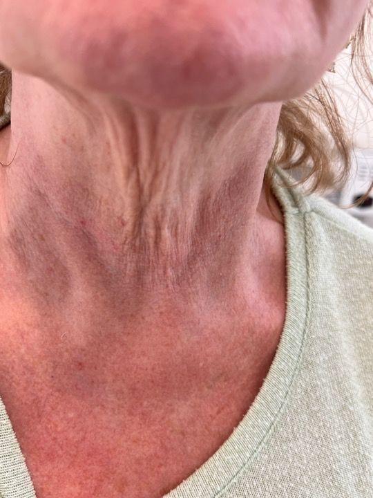 look before Neck Lift treatment
