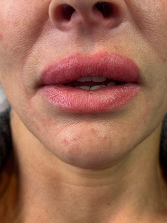 before Chin Filler treatment