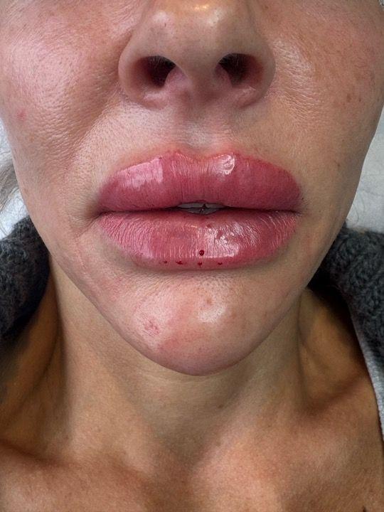 after Chin Filler treatment