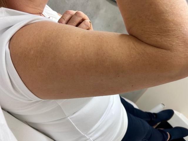 before Ultrasonic Cavitation treatment