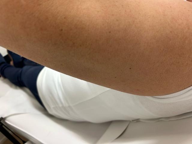 look before Ultrasonic Cavitation treatment