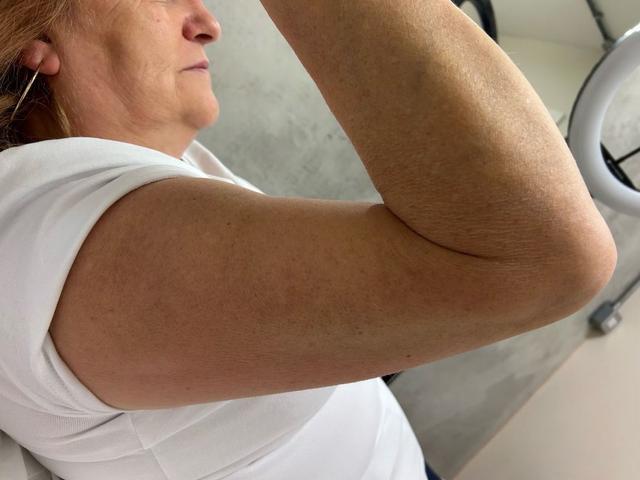 after Ultrasonic Cavitation treatment