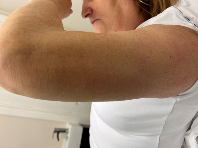 look after Ultrasonic Cavitation treatment