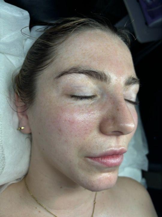 after Head Massage treatment