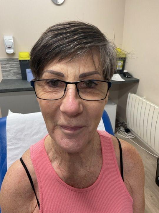 look before Profhilo treatment