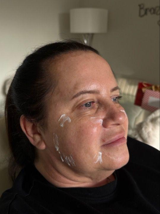 before Profhilo treatment