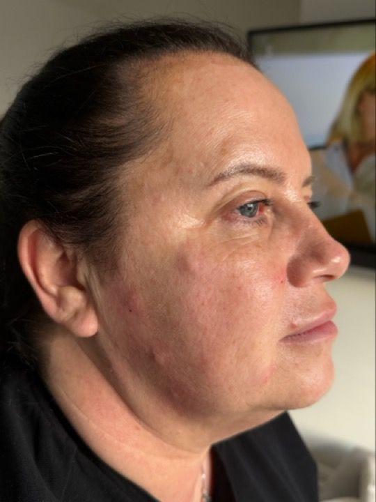 after Profhilo treatment