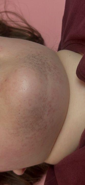 before Skin Tag Removal