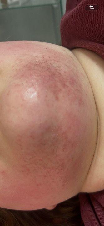 after Skin Tag Removal