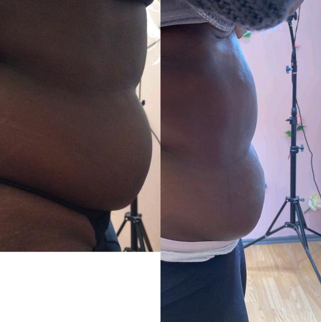 look after Fat Dissolving Injection treatment