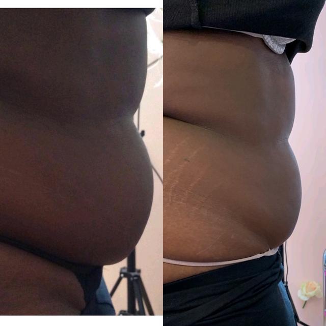 after Fat Dissolving Injection treatment