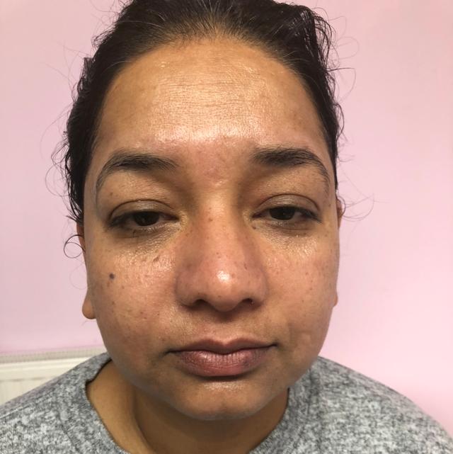 after Laser Hair Removal treatment