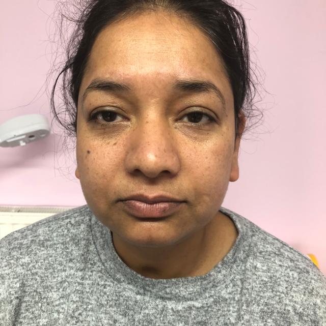 before Laser Hair Removal treatment