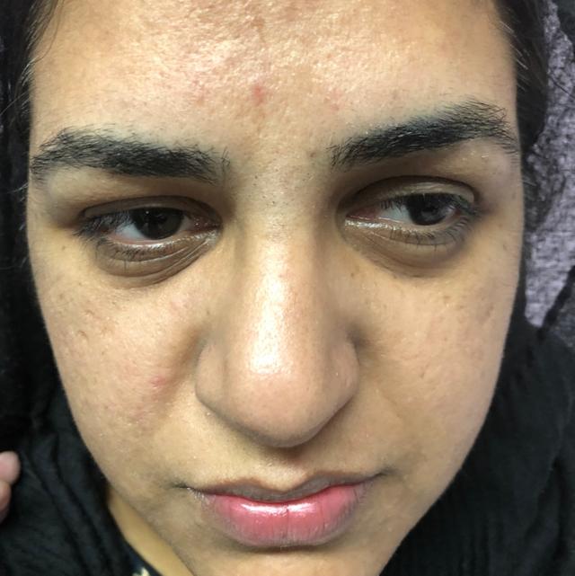 look before Laser Hair Removal treatment