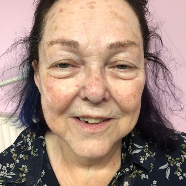 after Laser Hair Removal