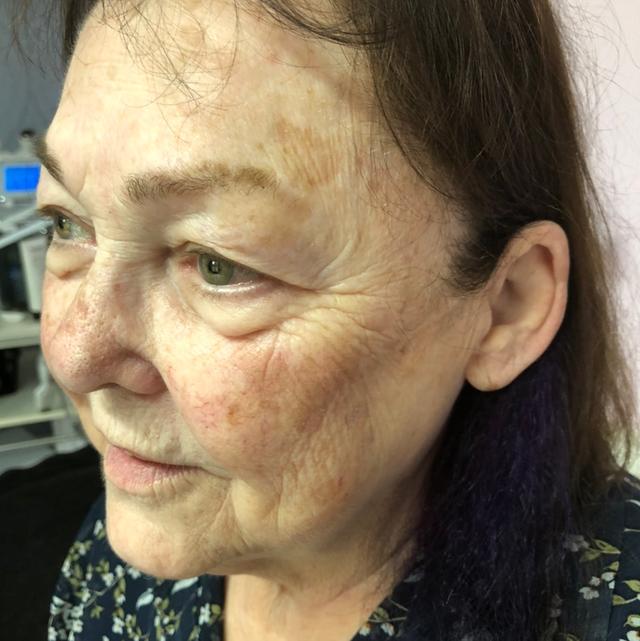 before Laser Hair Removal